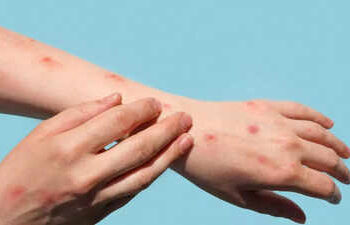 WHO declares global health emergency over Mpox outbreak