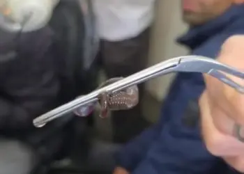 ENT Department GMC Anantnag Removes Large Snake-Like Worm from Boy’s Nostril