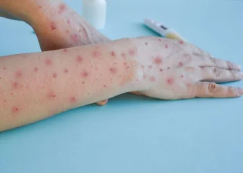 SKIMS on ‘alert’ for Mpox, set to ramp up testing