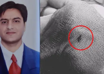 Kashmiri Doctor Performs Rare Brain Surgery, Saves 77-Year-Old Woman in Srinagar