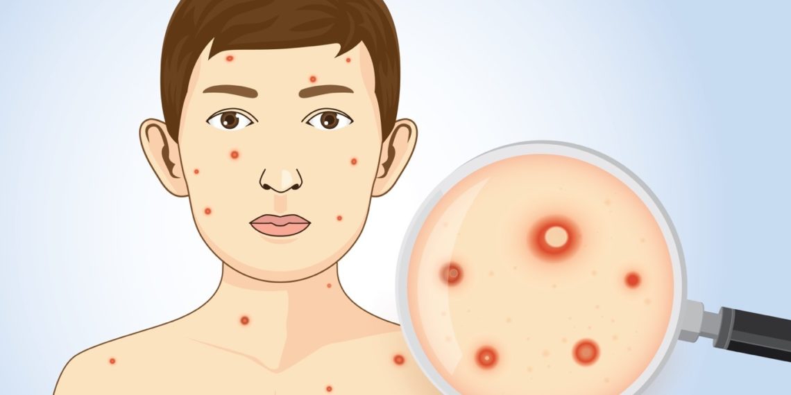 Case of chickenpox detected in Puthwari Nawgam Langate
