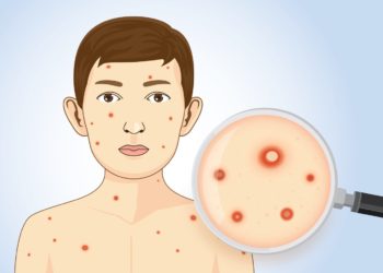 Case of chickenpox detected in Puthwari Nawgam Langate