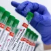 Mpox confirmed in man who travelled from country experiencing disease spread: Govt